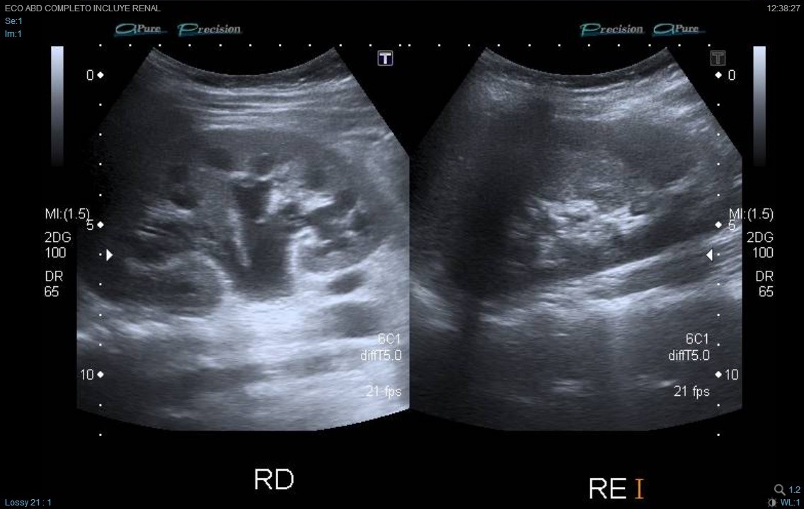 Figura 2. Imagen ecográfica, hidronefrosis renal derecha y riñón izquierdo normal