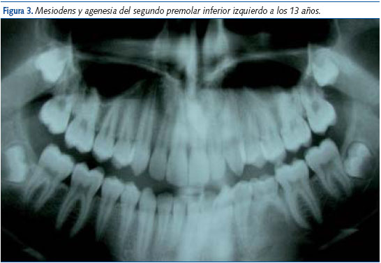 Figura 3. Mesiodens y agenesia del segundo premolar inferior izquierdo a los 13 años.
