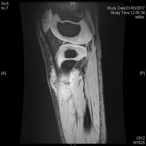 Figura 3. Resonancia magnética de partes blandas. Cuerpo extraño lineal (espina) que afecta a tejido celular subcutáneo, fascia, músculos tibial anterior y posterior y membrana interósea