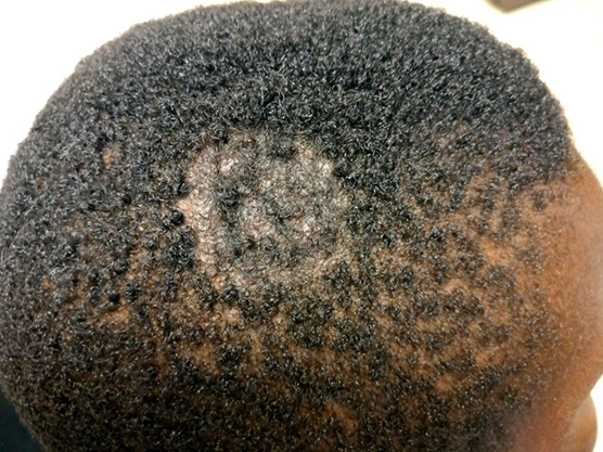 Figura 3. Lesión a los tres meses tras finalizar el tratamiento, con regeneración parcial del cabello
