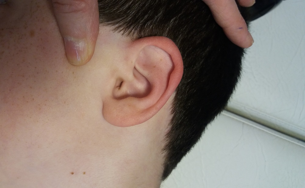 Orificio auditivo externo pequeño, en el mismo paciente, tras la extracción de cera