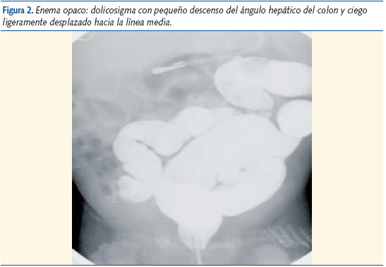 Figura 2. Enema opaco: dolicosigma con pequeño descenso del ángulo hepático del colon y ciego
ligeramente desplazado hacia la línea media.