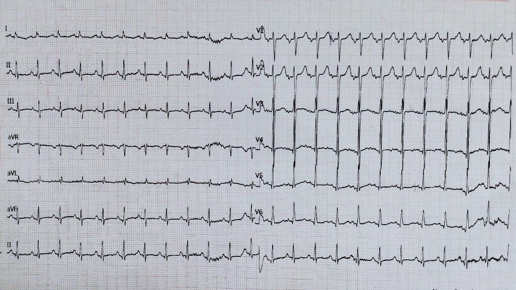 Electrocardiograma de superficie