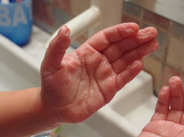 Aspecto macerado de palmas de ambas manos en la primera paciente (queratodermia acuagénica)
