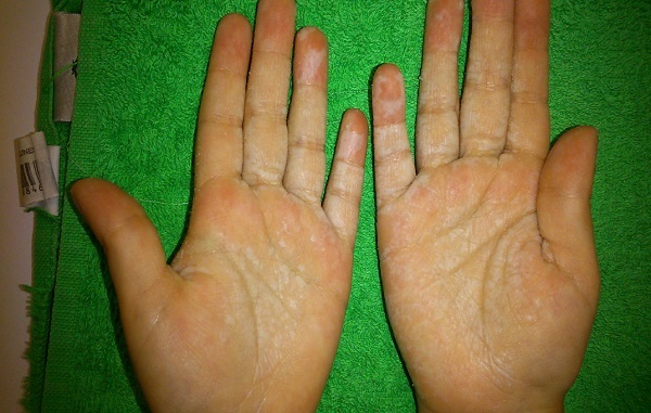 Lesiones blanquecinas en ambas palmas tras el baño en la segunda paciente (queratodermia acuagénica)