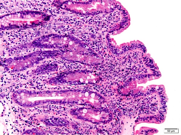 Figura 3. Corte histológico de duodeno teñido con hematoxilina-eosina. Se evidencia la tríada atrofia vellositaria moderada, hiperplasia críptica y linfocitosis intraepitelial