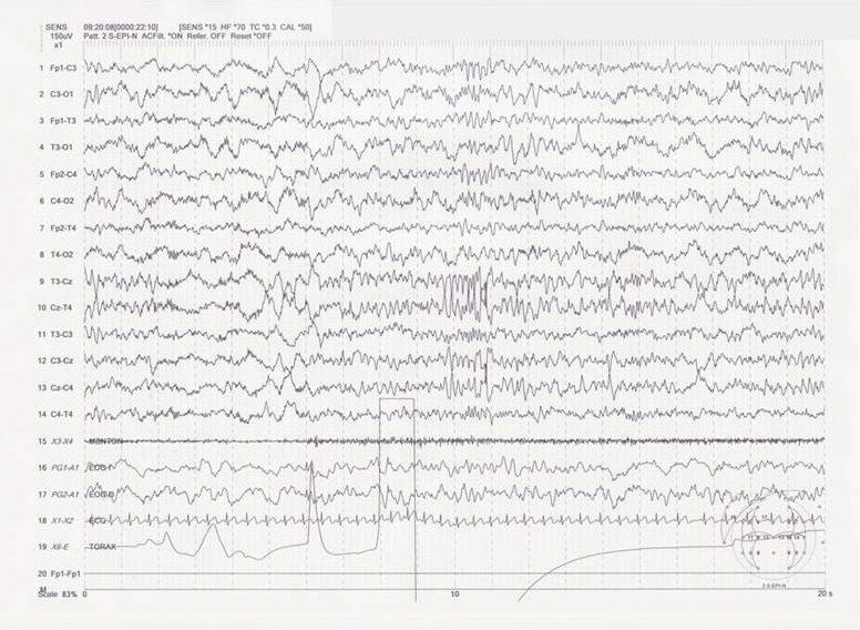 Figura 2. EEG de sueño diurno. Actividad tipo punta onda sobre regiones centrales con difusión a región bifrontal, en trenes de 5Hz durante el sueño nREM