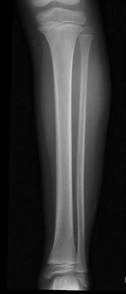 Figura 1. Radiografía de extremidad inferior izquierda en la que se observa aumento de partes blandas sin patología ósea