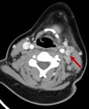 Figura 1. Imagen de TC (corte axial) en la que se visualiza trombosis yugular interna izquierda (flecha)