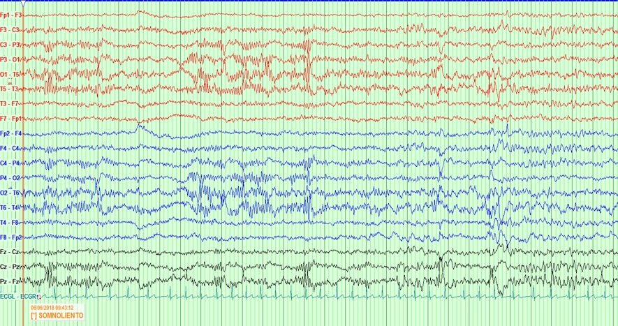 Electroencefalograma con actividad punta-onda 4-6 Hz bilateral de inicio en región temporal derecha