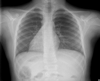 Radiografía de tórax