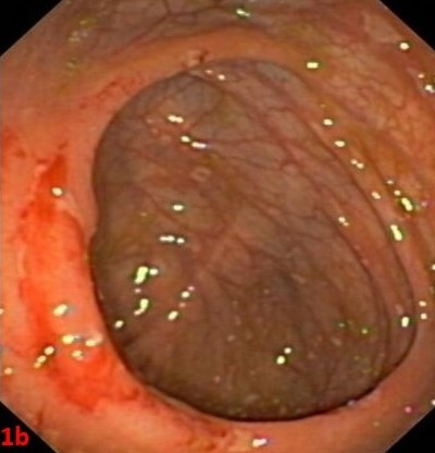 Ulceraciones parcheadas a lo largo de todos los tramos de colon