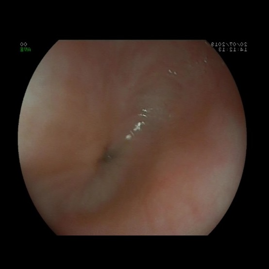 Figura 1. Estenosis esofágica con orificio puntiforme a unos 15 cm de la arcada dental