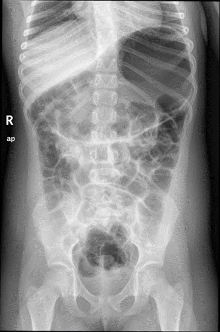 Figura 1. Radiografía simple de abdomen que muestra una distensión gástrica llamativa y abundante gas en todo el tracto gastrointestinal