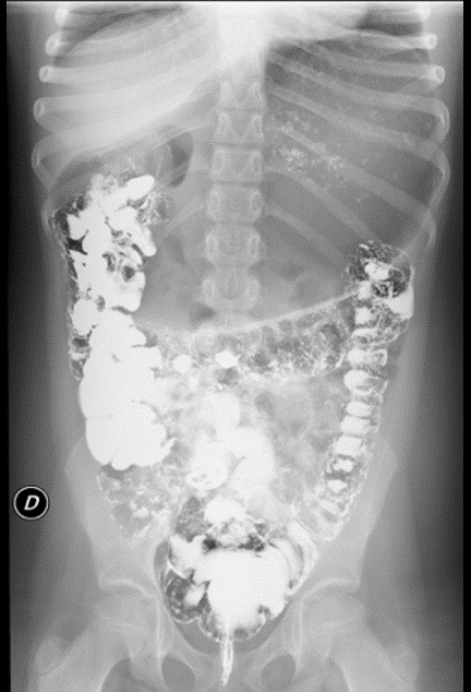 Figura 3. Radiografía simple de abdomen realizada unas horas tras el tránsito baritado que muestra una distensión gástrica muy marcada