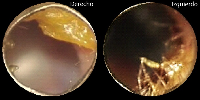 Figura 1. Imagen de otoscopia que muestra hemotímpano bilateral