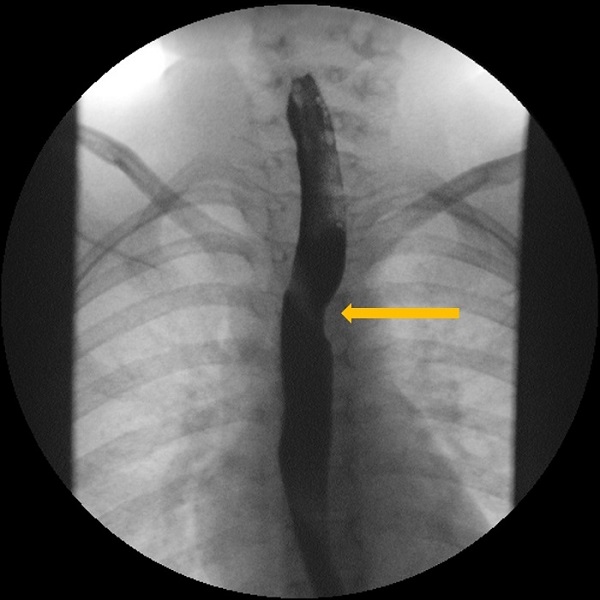 Figura 1. Estudio esófago-gastroduodenal con contraste baritado. Proyección anteroposterior. Se observa la impronta oblicua de la arteria subclavia derecha aberrante (ARSA) en el tercio medio esofágico 