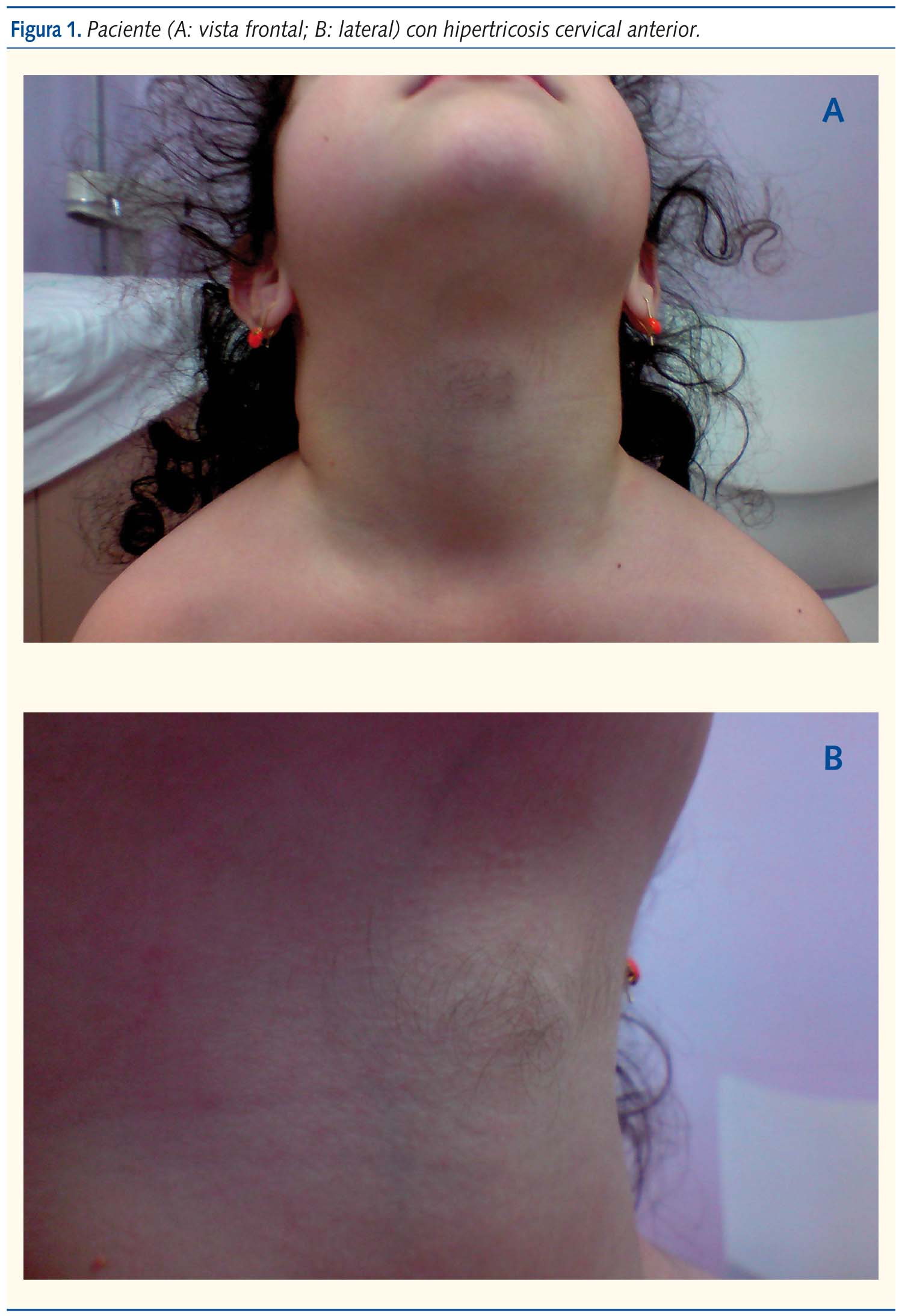 Figura 1. Paciente (A: vista frontal; B: lateral) con hipertricosis cervical anterior.