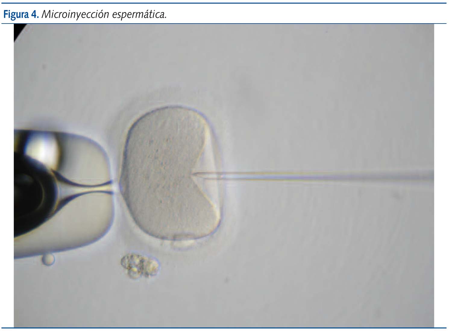 Figura 4.Microinyección espermática