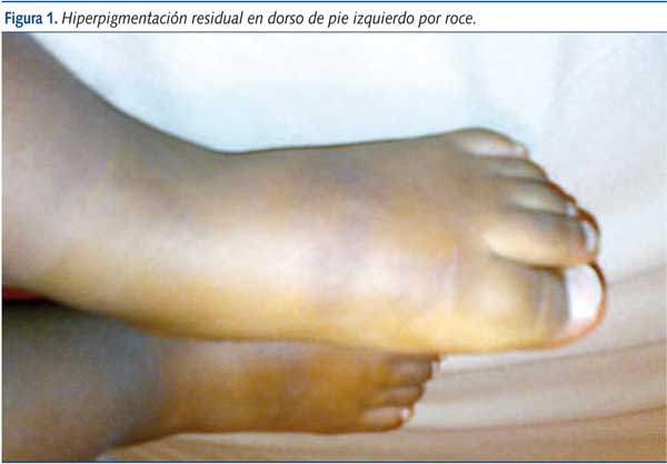 Figura 1. Hiperpigmentación residual en dorso de pie izquierdo por roce.