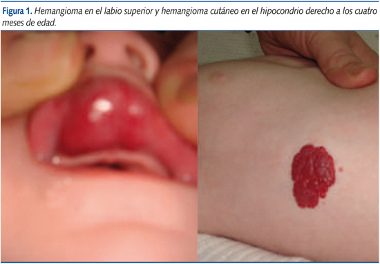 Figura 1. Hemangioma en el labio superior y hemangioma cutáneo en el hipocondrio derecho a los cuatro meses de edad.