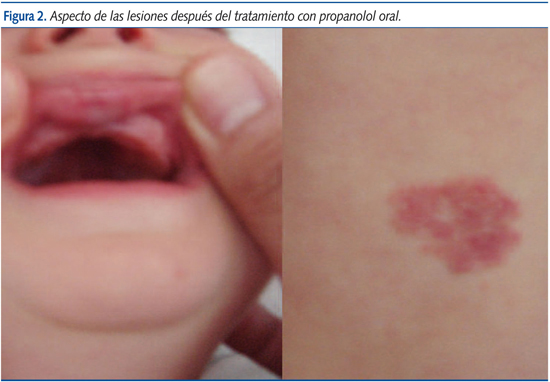 Figura 2. Aspecto de las lesiones después del tratamiento con propanolol oral.