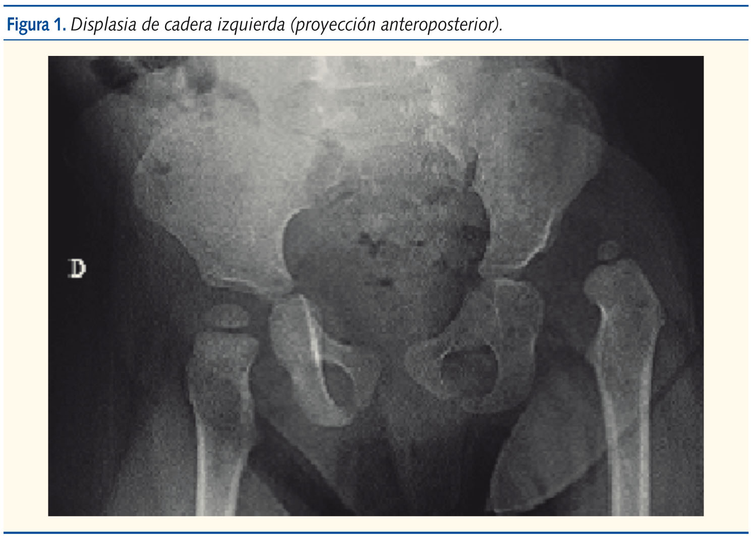 Figura 1. Displasia de cadera izquierda (proyección anteroposterior).
