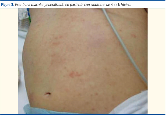 Figura 3. Exantema macular generalizado en paciente con síndrome de shock tóxico.