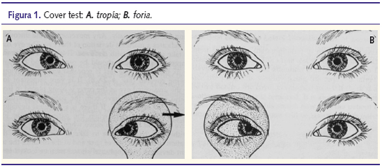 Figura 1. Cover test: A. tropía; B. foria.
